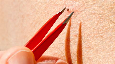 Ingrown Hair Heal On Its Own at Brianna Rocher blog