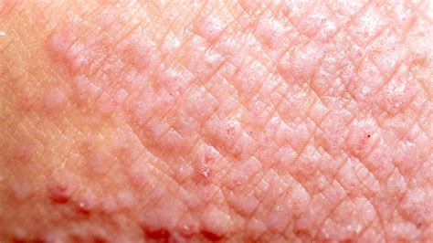 What Is Eczema, What Makes Eczema Flare Up – NXFJO