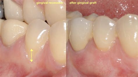 Gingival Graft for Treatment of Gum Recession | Gingival Graft for Treatment of Gum Recession ...
