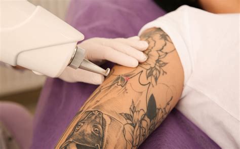 Is Removing a Tattoo Painful?