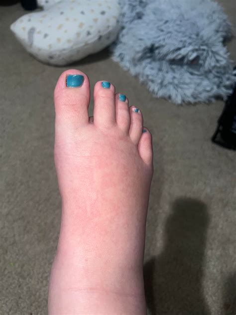 Intense itching while pregnant : r/medical_advice