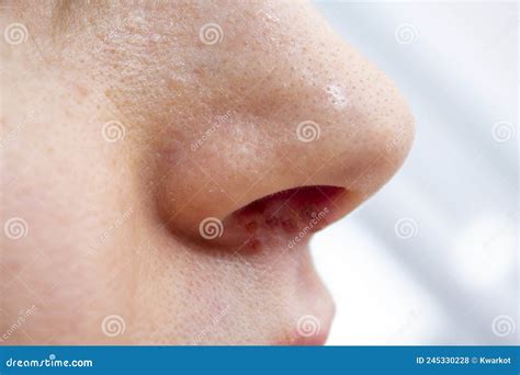 Herpes On Nose