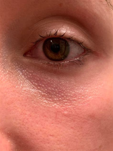 [Skin Concerns] Has anyone found a solution for visible oil glands (chicken skin) under eyes ...