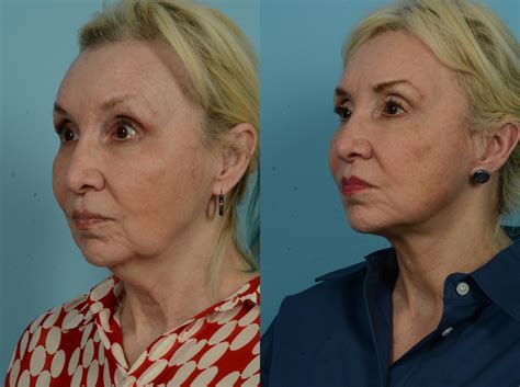 Deep Plane Facelift Expert in Chicago, IL, Dr. Thomas Mustoe – TLKM Plastic Surgery