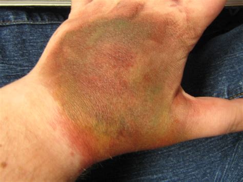 Chemical Burn On Hands From Cleaning Products at Matthew Greeves blog