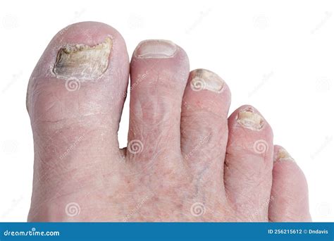 A Toenail Fungus At The Peak Of The Infection. Painful Toe Contagious With Onychomycosis. Active ...