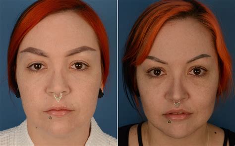 Lip Surgery Before | Lauren Sanchez Is Unrecognizable In Throwback Pic Before Plastic Surgery ...