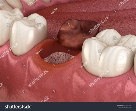 233 Dry sockets Stock Illustrations, Images & Vectors | Shutterstock