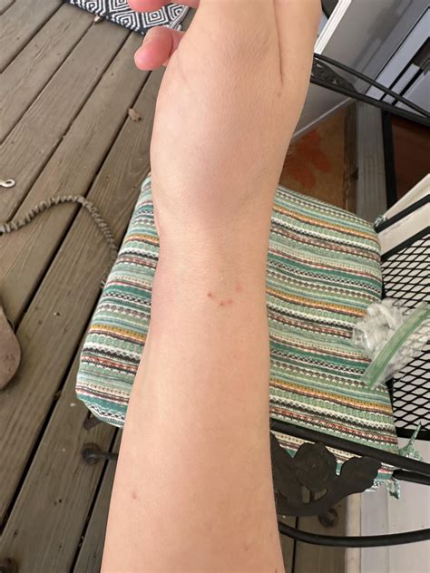 Popped blood vessel in wrist : r/Anatomy