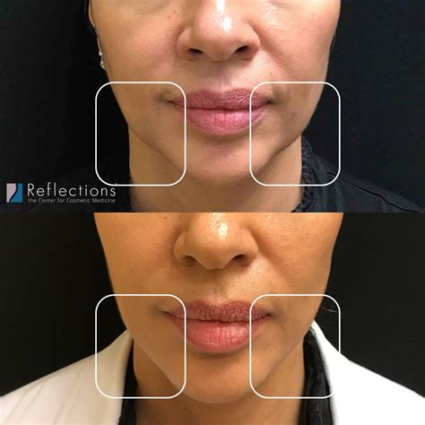 Complete guide to injectable fillers – Artofit