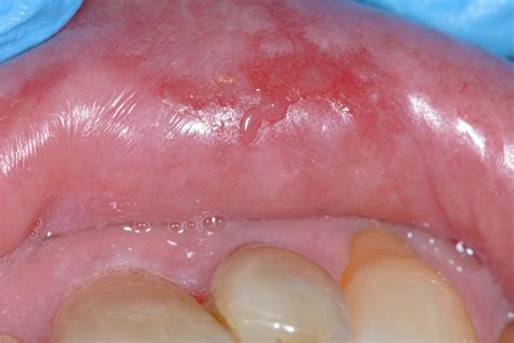 Atrophic Lichen Planus Tongue
