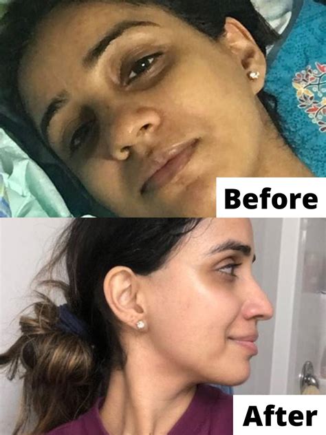 How I improved my Hyperpigmentaion | For Dark and Brown Skin | Melanin ...