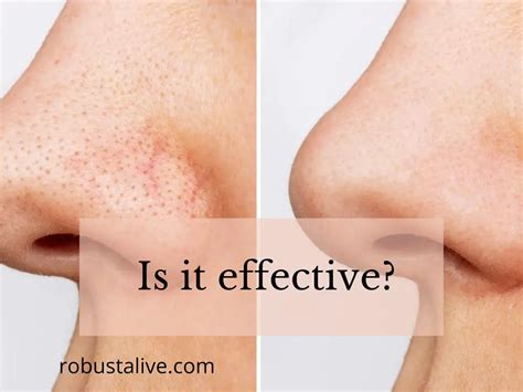 Blackhead Removal with Accutane - Is It Effective?