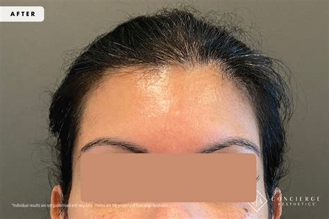 B and A - Botox Cosmetic - Forehead Lines