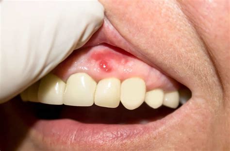 How to Tell the Difference Between a Canker Sore and Gum Infection