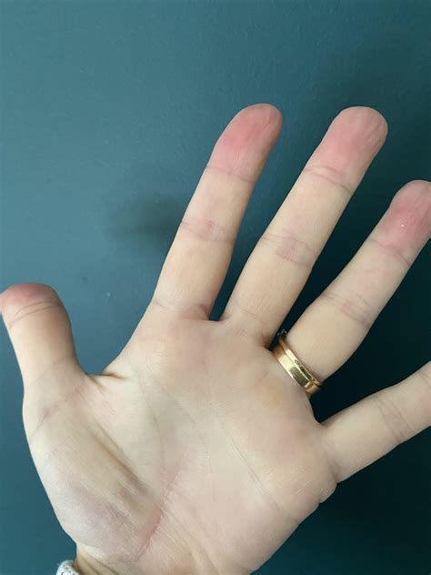 Why Are My Fingertips Red And Numb at Mia Rooke blog