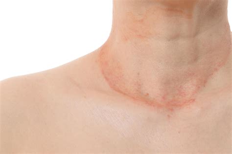Is Eczema Contagious? Myths, Truths & Advice