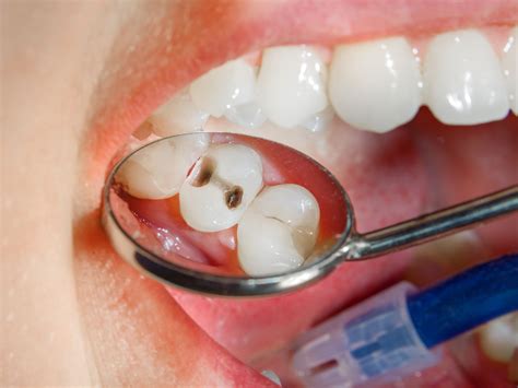 Composite Fillings - Abay Dental