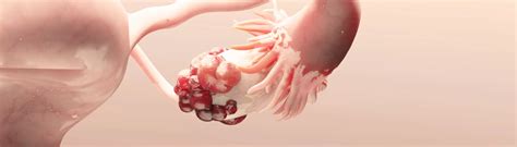 Can Ovarian Cysts Cause Infertility?