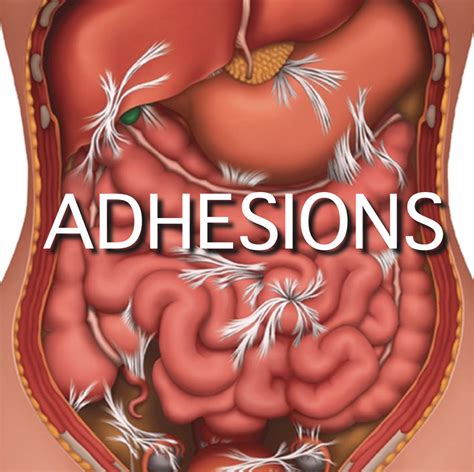 What is Abdominal Adhesiolysis? | Hill Regional Hospital