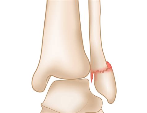 Lateral Malleolus Fracture