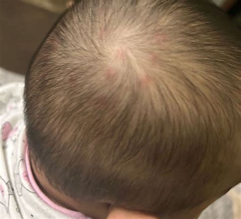 7MO red bumps on scalp | BabyCenter