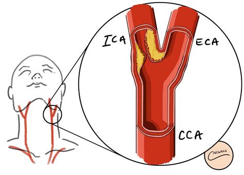 Symptoms Of Plaque In Carotid Arteries at Daryl Reif blog