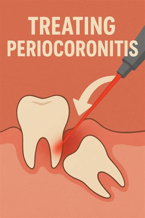 Laser Gum Treatment for Pericoronitis - OC Perfect Smile Dental