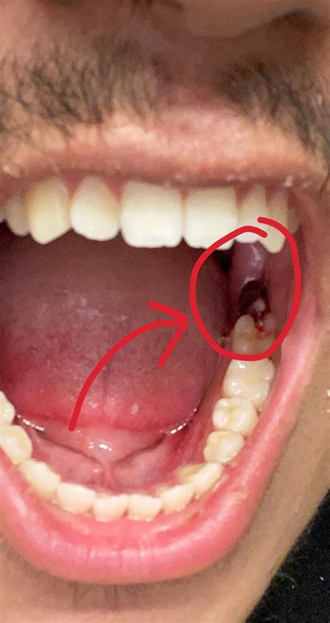 Day 2 post wisdom teeth removal. Anyone know what this is? It’s kind of touching my molar. If it ...