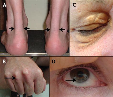High cholesterol, causes, signs, symptoms, diagnosis, treatment & prognosis