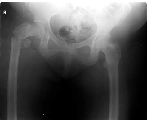 Understanding Bone Fracture X-Rays