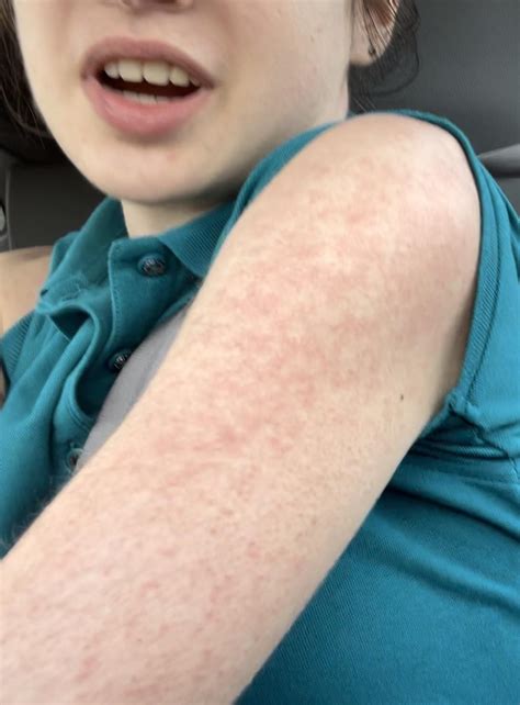 Unexplained, recurrent rashes on upper body : r/medical
