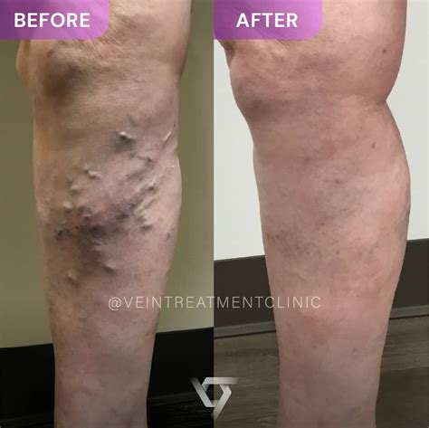 Why Are Veins Popping Out on My Legs or Feet? | Causes & What to Do | Vein Treatment Clinic