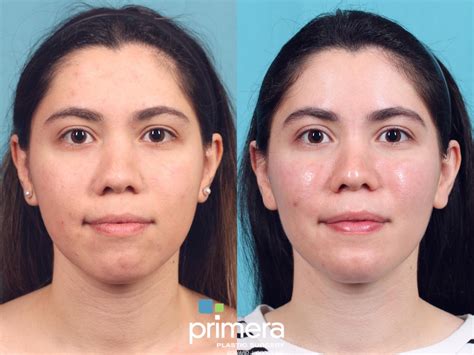 Buccal Fat Removal Images at Ava Ewers blog