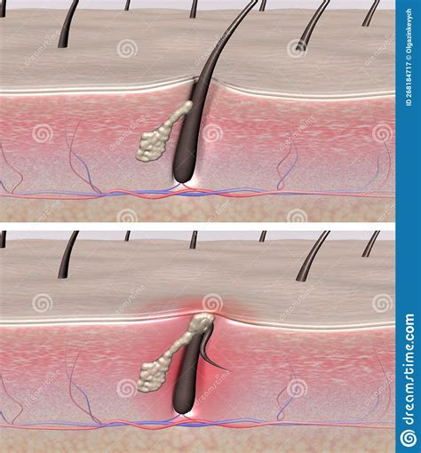 Healthy Hair Follicle and Inflamed with Acne and Ingrown Hair Stock Illustration - Illustration ...