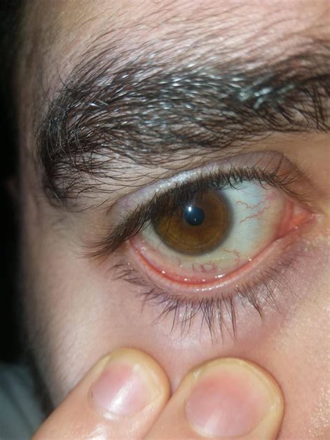 Swollen Eye Veins at David Sells blog