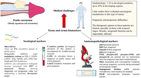 Clinical and Novel Biomarkers in Penile Carcinoma: A Prospective Review