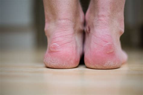 Blisters Care & Relief | Well Heeled Podiatry Hampton, Melbourne