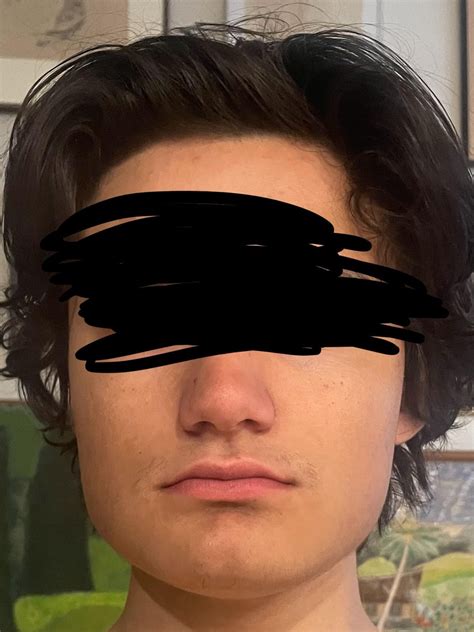 Another angle of my face for what I believe is short face syndrome : r/jawsurgery