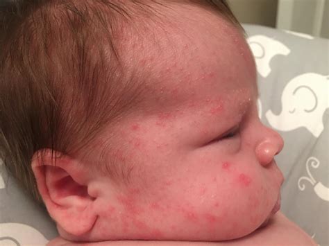 Why Does My Baby Have A Rash On Her Neck at Tarah Gordon blog