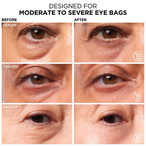 How To Reduce Eye Bags