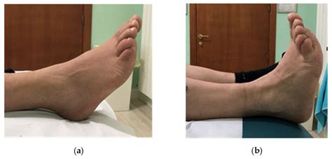 Ganglion The Foot And Ankle Online Journal Pain On Top Of Foot: