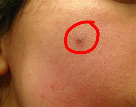 How do I get rid of this pimple that won't come to a head or go away? : r/SkincareAddiction