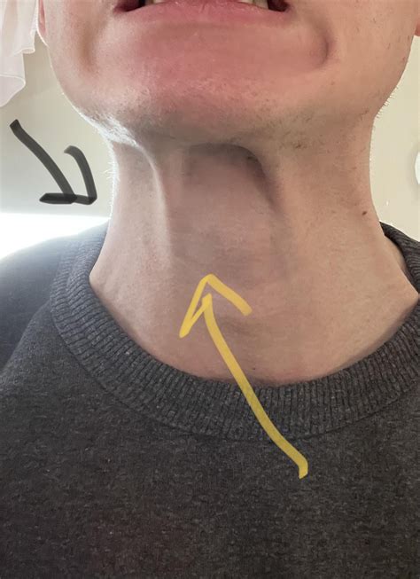 Tendons (?) popping out when I pull my lower jaw in, can someone ...