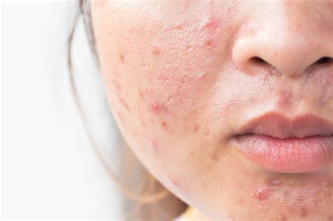 What Causes Itchy Rosacea And How To Soothe It - SL Aesthetic Clinic