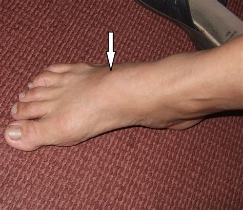 Bump On Foot