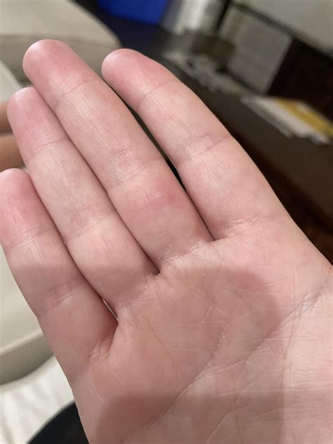 Small Painful Bumps on Palm Side of Fingers - Come & Go Every Few Days & Feels Like Splinter : r ...