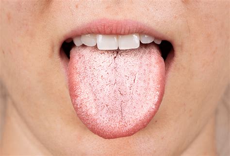 Oral Thrush | Advice and treatment | Rowlands Pharmacy