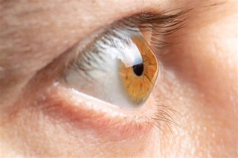 How Long Does It Take to Heal After Corneal Cross-Linking Surgery?