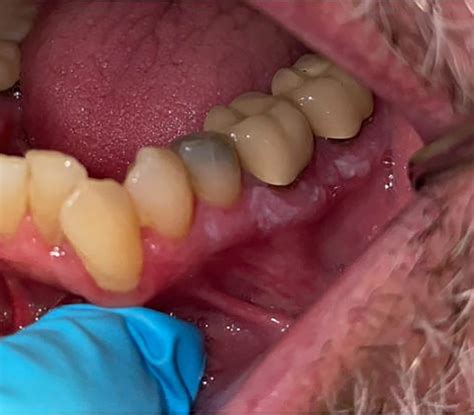 Treatment of Oral Dysplasia - Dental Clinics